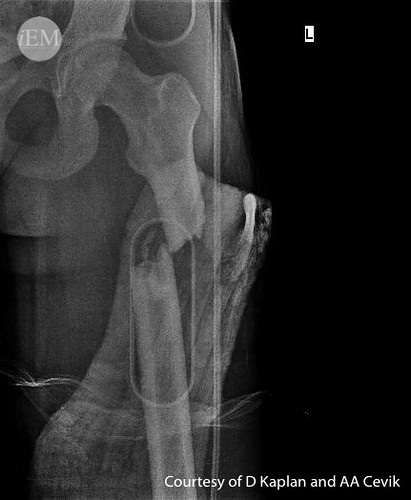 fracture femur2