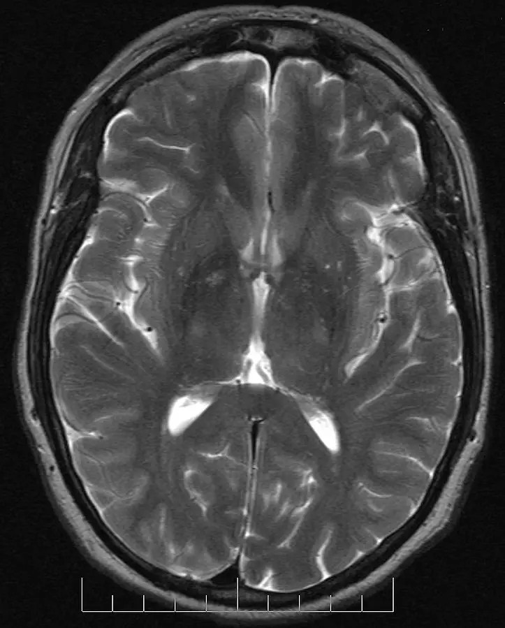 intracranial hypertension