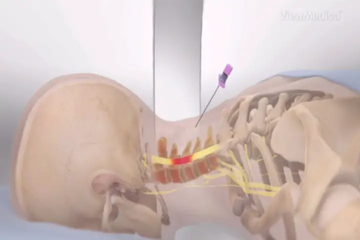 infiltração cervical