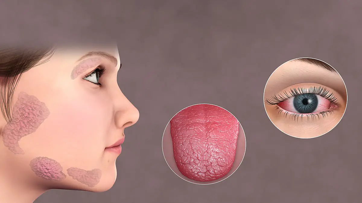 symptômes du syndrome de sjorgren