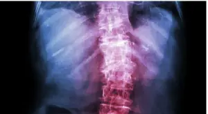 Back osteoarthritis pain in the middle of the back
