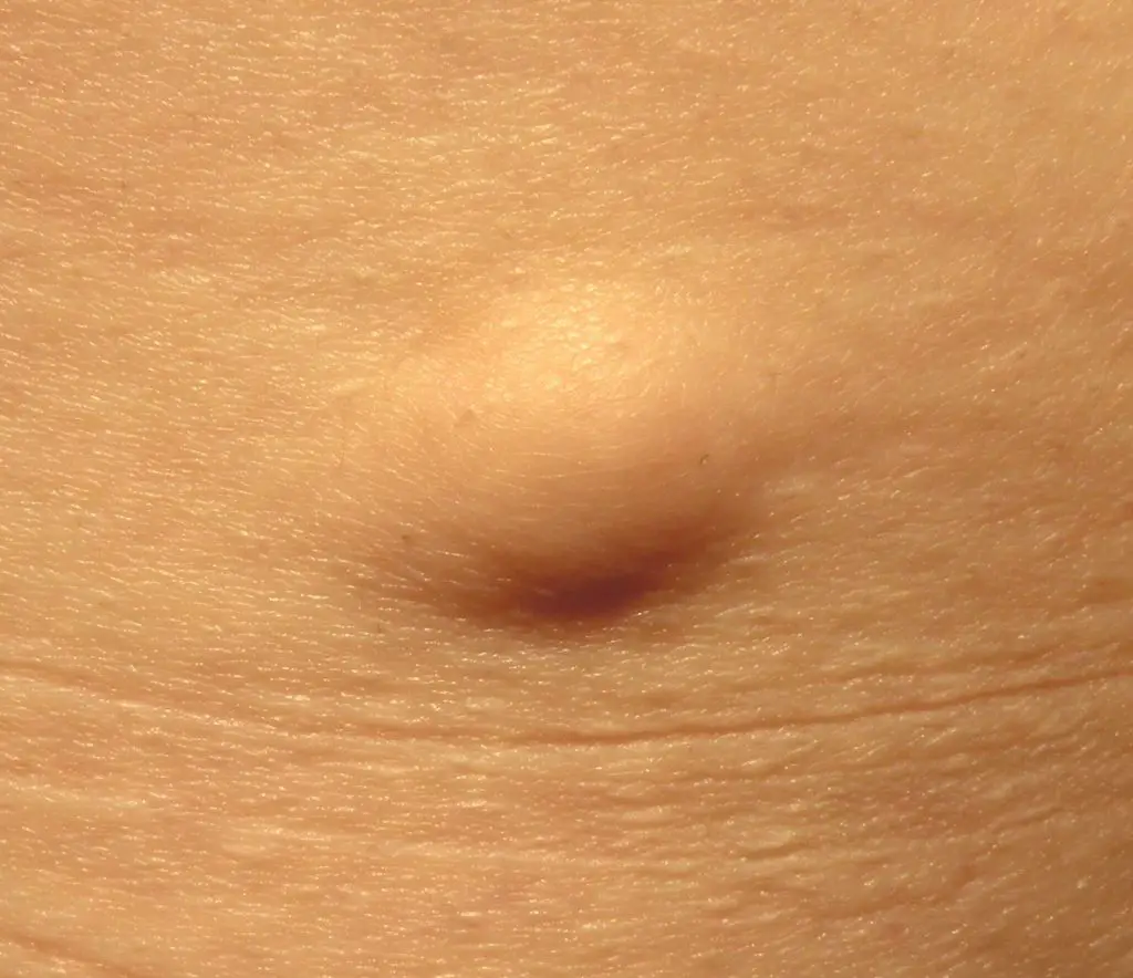 lipoma