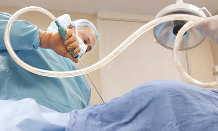 Liposuccion