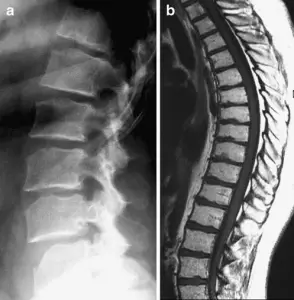 mri af scheuermanns sygdom