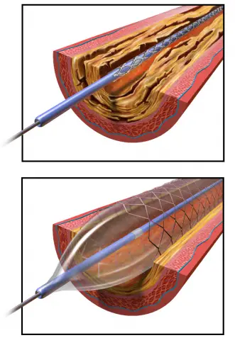 angioplastie et pose d'un stent
