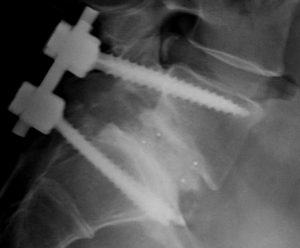 lumbal artrodese