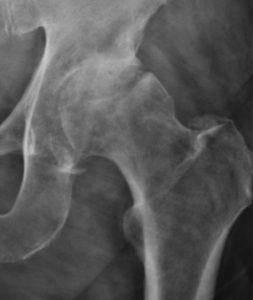 hofteslidgigt diagnosticeret ved billeddiagnostik (radiografi)