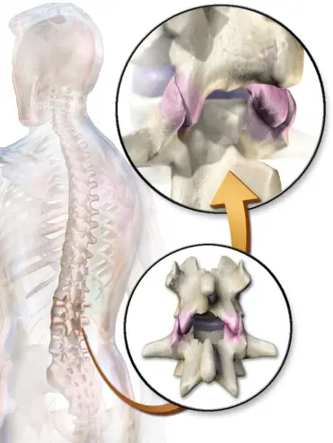 Arthrose des Zygapophysealgelenks