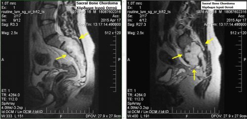 sakromal cancer (chordoma)