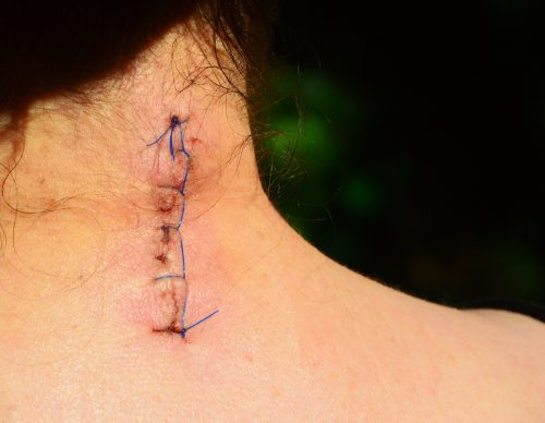 cicatrice et douleur suite à une chirurgie cervicale