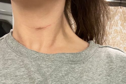vordere zervikale Chirurgie