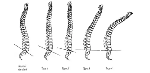 lumbar kyphosis