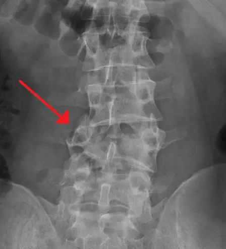 fractura lumbar