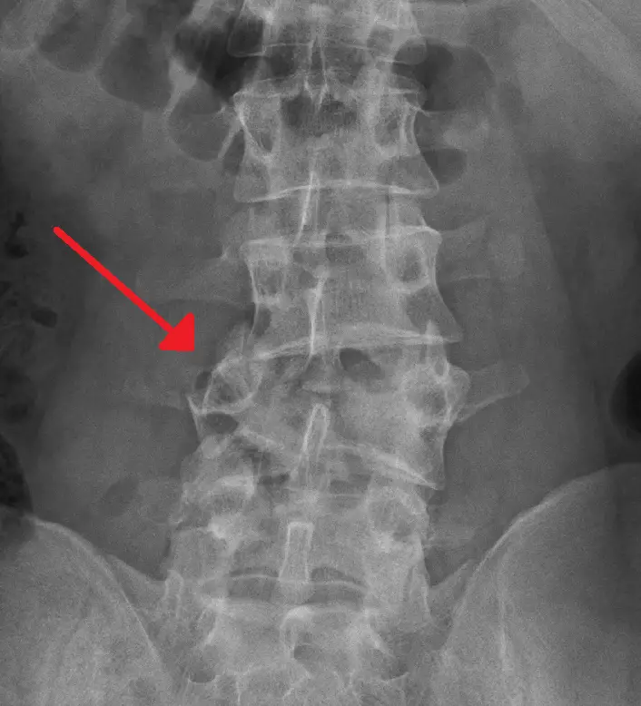 lumbar fracture