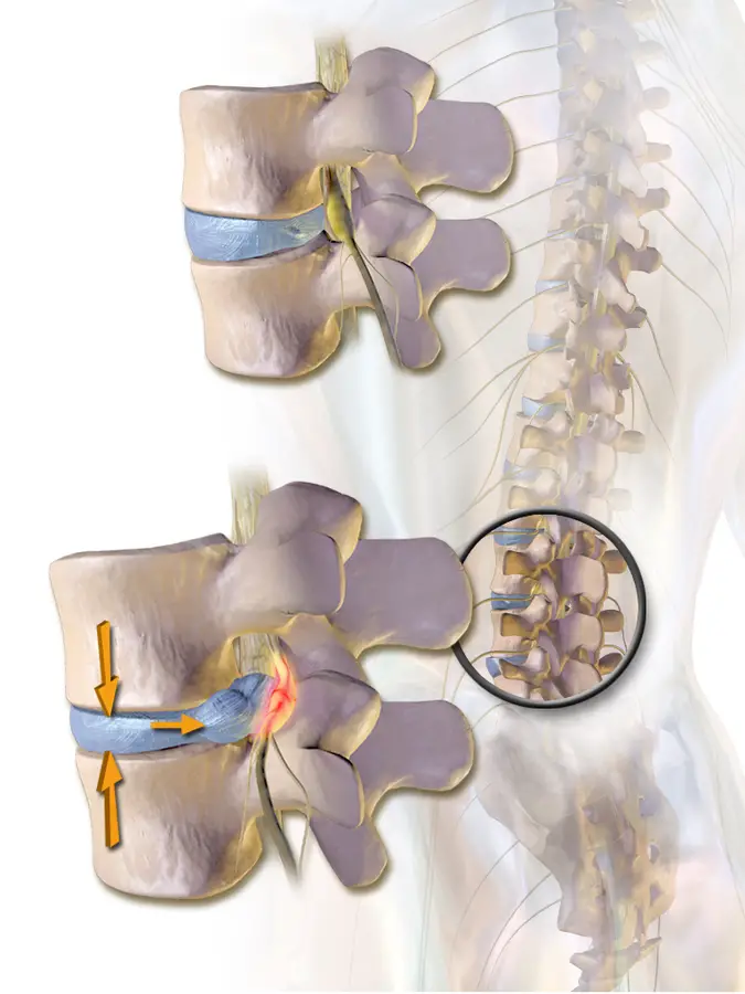 https://commons.wikimedia.org/wiki/File:Herniated_Disc.png