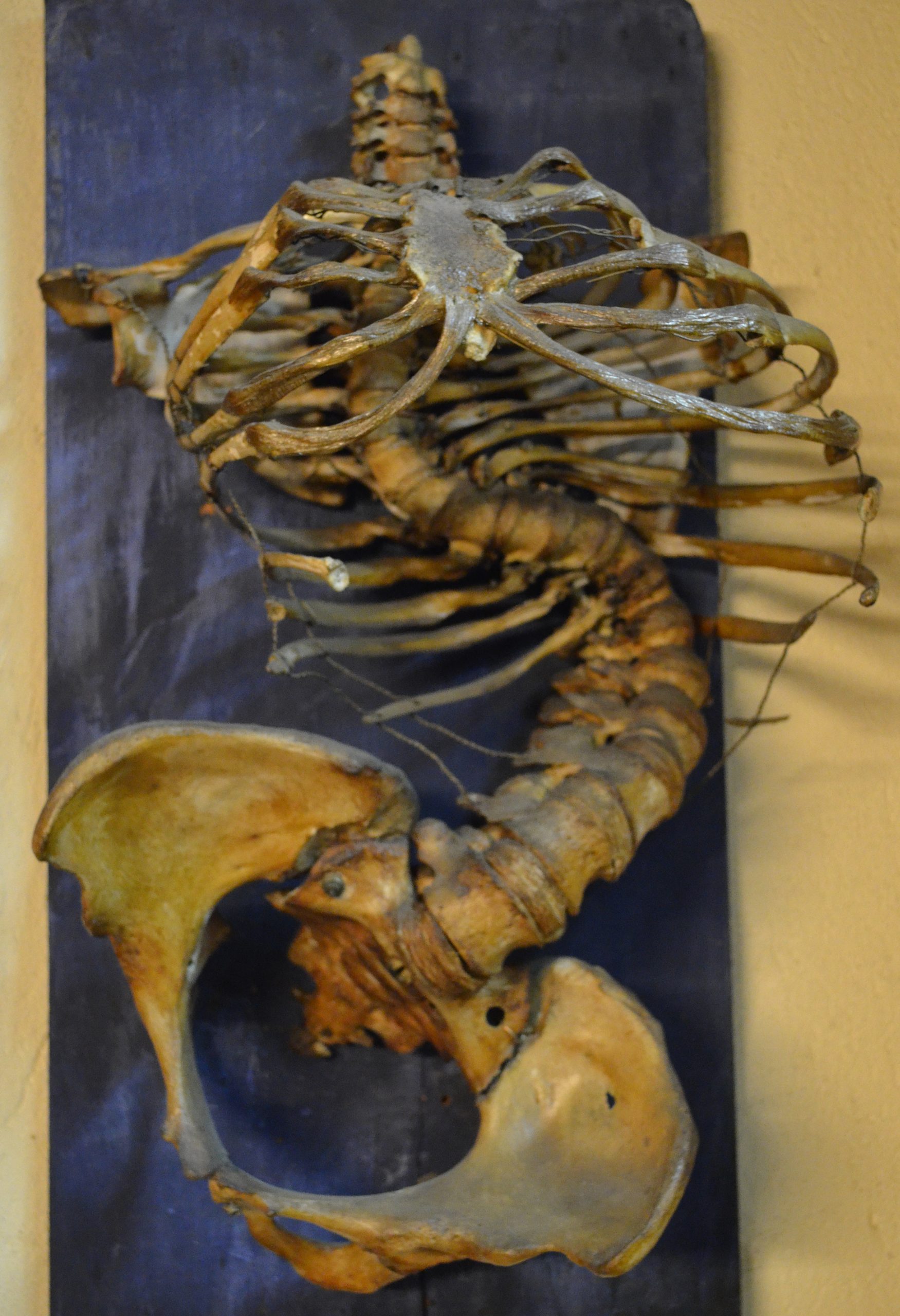 Enfermedad de Pott Diagnóstico y manejo (¿Qué hacer?) El dolor de espalda popularizado por