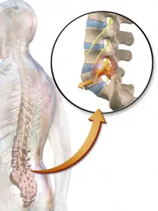 spondylolistese