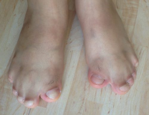 foot syndactyly