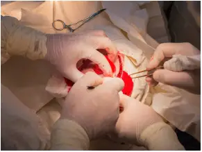Kranoperation Kranioplastik