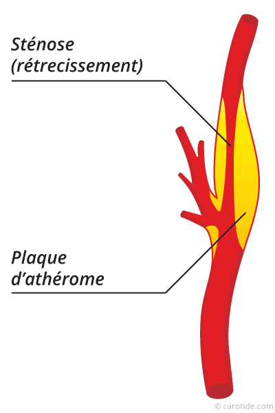 Karotisstenose