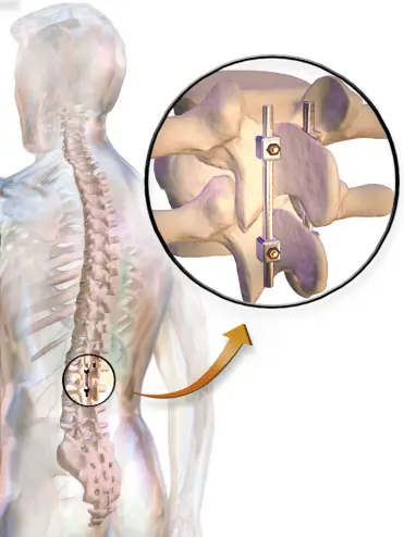 lumbale Arthrodese