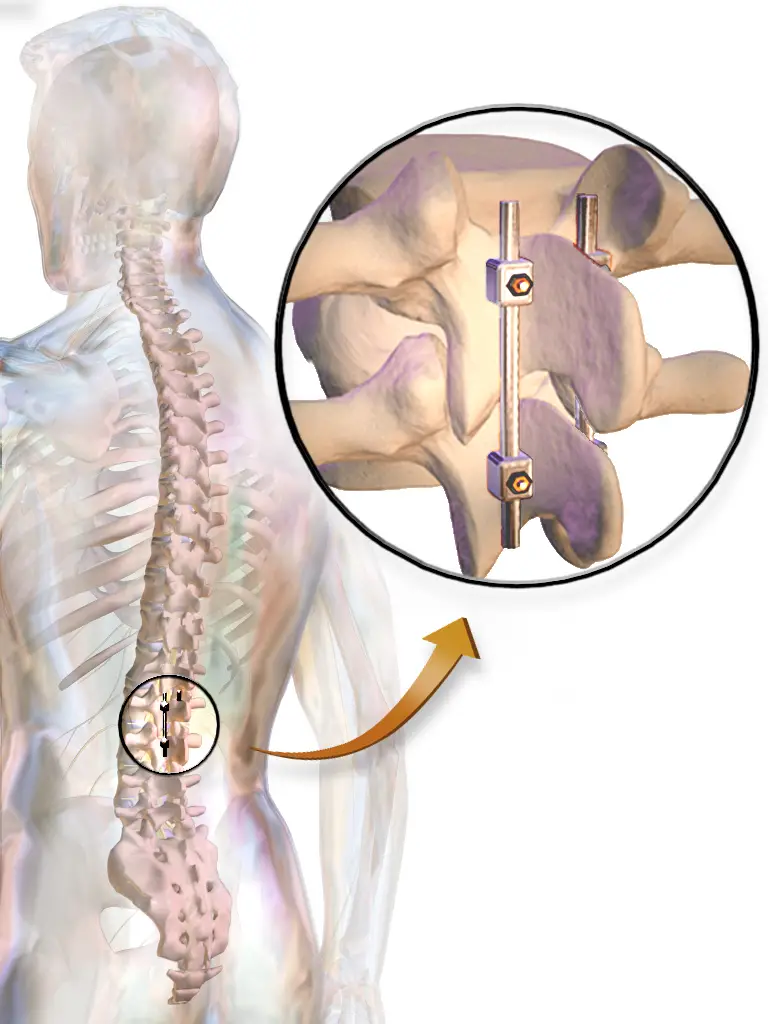 arthrodèse lombaire