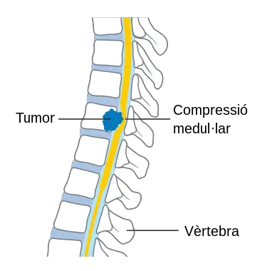 Rückenmarkskrebs