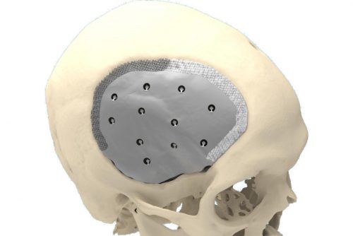 cranioplastia Cranioplastia