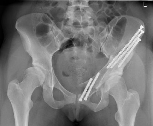 Pelvic fracture: Duration of hospitalization (how long?)