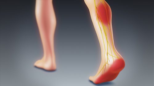 sciatica mimicking calf pain