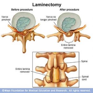 laminectomy