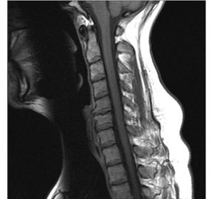 頸部MRI
