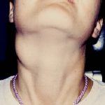 neck mass