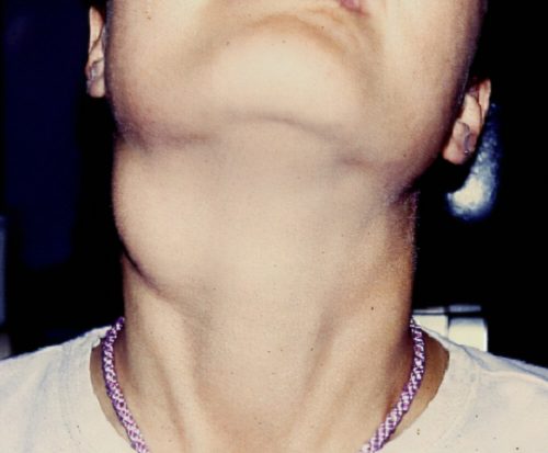 neck mass