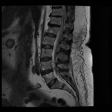 lumbar cyst