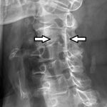 cervical foraminal stenosis