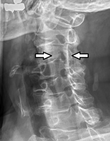 cervical foraminal stenosis