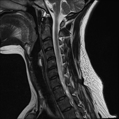 MRI cervicale Nevralgia d'Arnold e acufeni