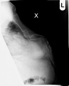 Radiografia padrão da fratura do esterno