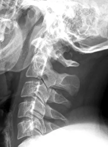 espondilose cervical