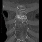 Broken sternum: what to do in case of fracture?