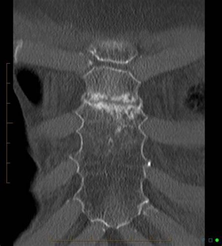 fracture sternum éventration abdominale