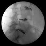 discografía lumbar