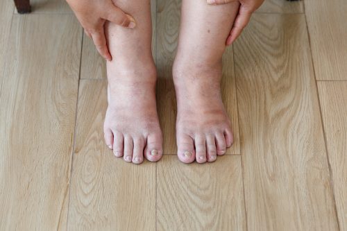 AdobeStock 279994787 scaled 1 Swollen feet: grandmother's remedies