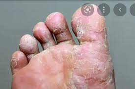 telechargement Démangeaisons des pieds