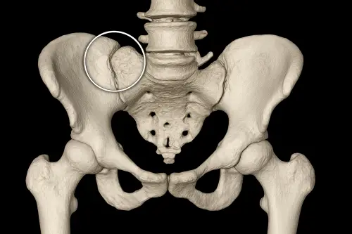 sacralization of the fifth lumbar vertebra (L5)